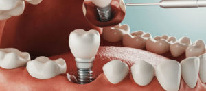 Implant dentaire avec couronne