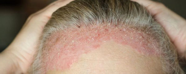 psoriasis